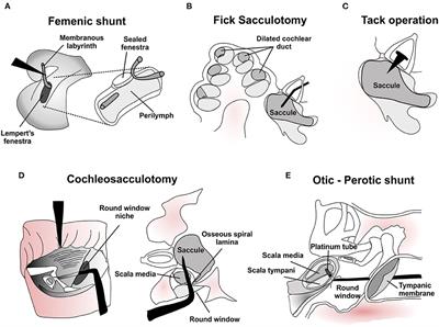 A Historical Perspective on Surgical Manipulation of the Membranous Labyrinth for Treatment of Meniere's Disease